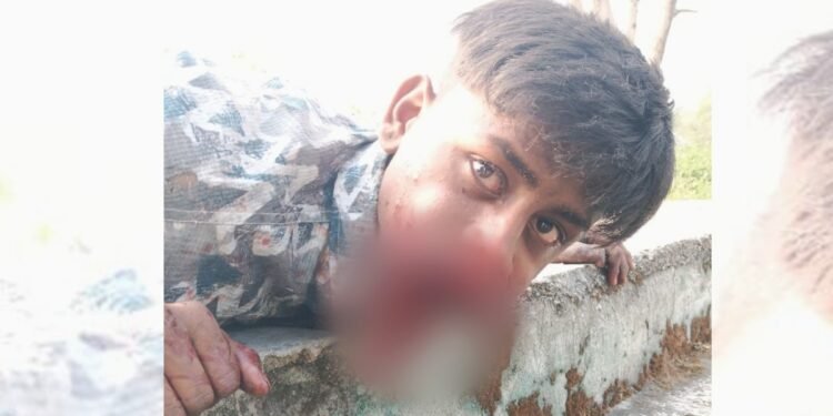 हीरोगिरी पड़ी भारी… मुंह में सुतली बम फोड़ रहा था 18 साल का रोहित, हुआ तेज धमाका; जबड़े के उड़ गए चिथड़े