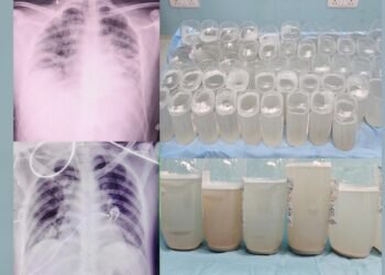 एम्स भोपाल ने पहली बार की फेफड़ों की ‘डीप क्लीनिंग’, डॉक्टरों ने सलाइन वाटर से धोकर निकाली धूल