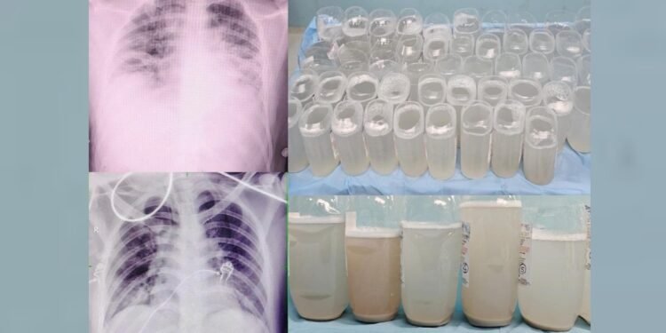 एम्स भोपाल ने पहली बार की फेफड़ों की ‘डीप क्लीनिंग’, डॉक्टरों ने सलाइन वाटर से धोकर निकाली धूल