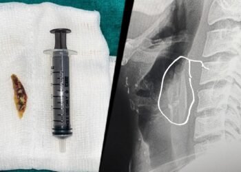 गले में फंसी चिकन की हड्डी, युवक की हालत हो गई खराब… जान बचाने के लिए करानी पड़ी सर्जरी