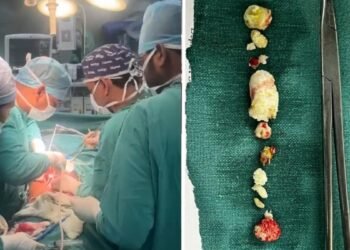 महिला के पैन्क्रियाज से निकाले 15 से अधिक पत्थर, 2 सेमी के स्टोन देख डॉक्टर भी हैरान