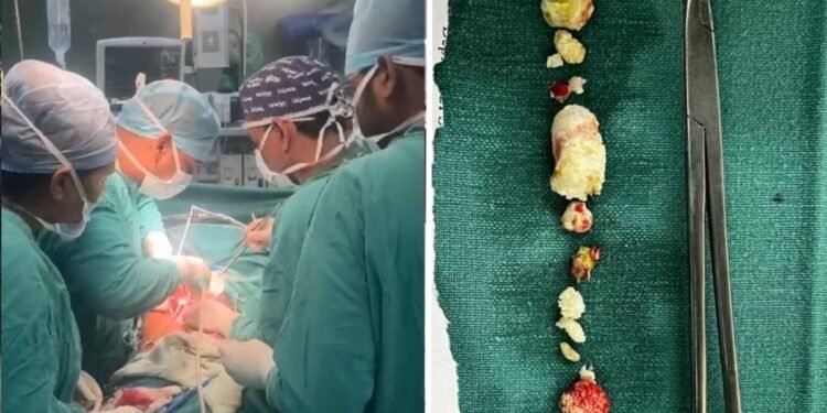 महिला के पैन्क्रियाज से निकाले 15 से अधिक पत्थर, 2 सेमी के स्टोन देख डॉक्टर भी हैरान