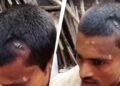 बिहार: सिर फटने पर डॉक्टर ने टांकों की जगह लगा दी स्टेपलर पिन, Video Viral