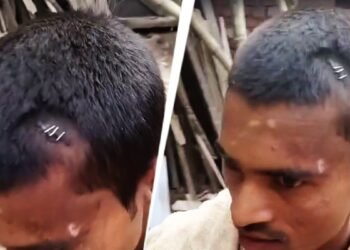 बिहार: सिर फटने पर डॉक्टर ने टांकों की जगह लगा दी स्टेपलर पिन, Video Viral