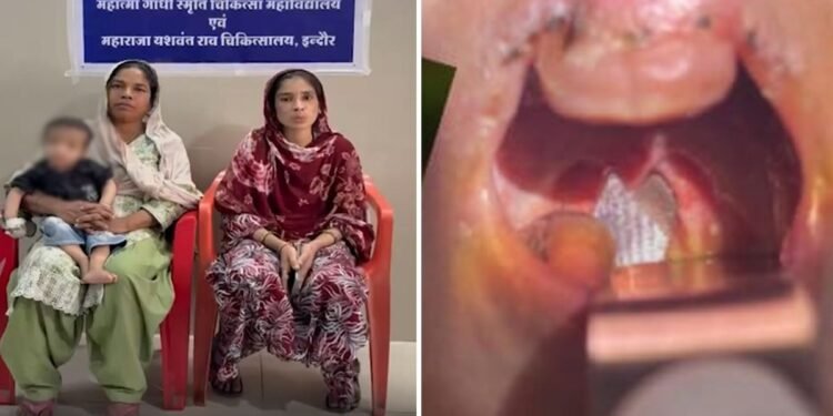 इंदौर: एक साल के बच्चे के गले में फंसी जिंदा मछली, खेल-खेल में निगल गया था, डॉक्टरों ने ऑपरेशन कर बचाई जान