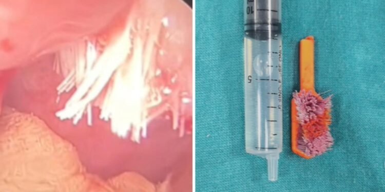 मौत के मुंह से वापस आया 5 साल का मासूम! ब्रश करते समय टूटकर गले में फंसा टूथब्रश, डॉक्टरों ने ऐसे बचाई जान