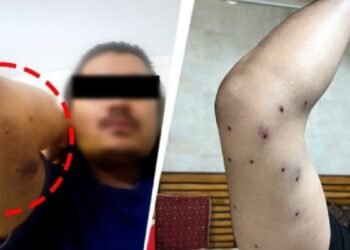 Exclusive: दिल्ली में चली पैलेट गन… घायल प्रदर्शनकारी के जख्म-मेडिकल रिपोर्ट दे रहे गवाही