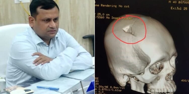 छपरा में पथराव का शिकार हुए BDO के सिर की सर्जरी, हालात संभालने गए थे, खुद पहुंच गए अस्पताल